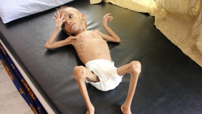 O inferno da guerra do Iémen. Fotos de crianças moribundas chocam o mundo. Crónica de Luísa Semedo